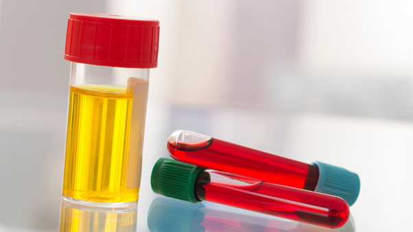 血尿とは？知っておきたい基本