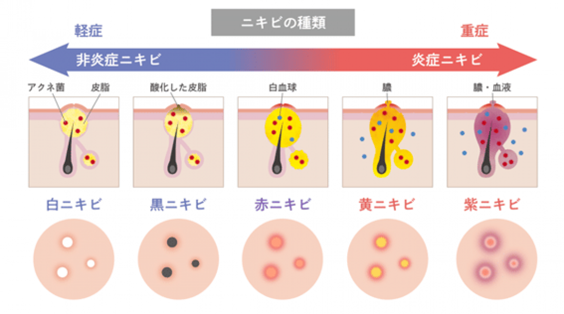 【漢方薬剤師が解説】大人ニキビの弁証論治